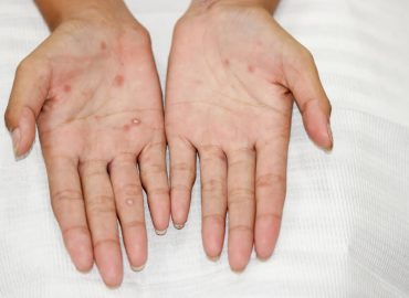Breaking the Chain: How Syphilis TP-Ab Screening Can Stop the Spread
