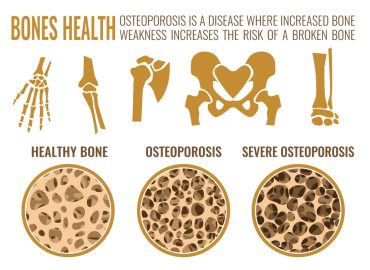 Bone Density Tests: The Key to Early Detection of Osteoporosis in Malaysia