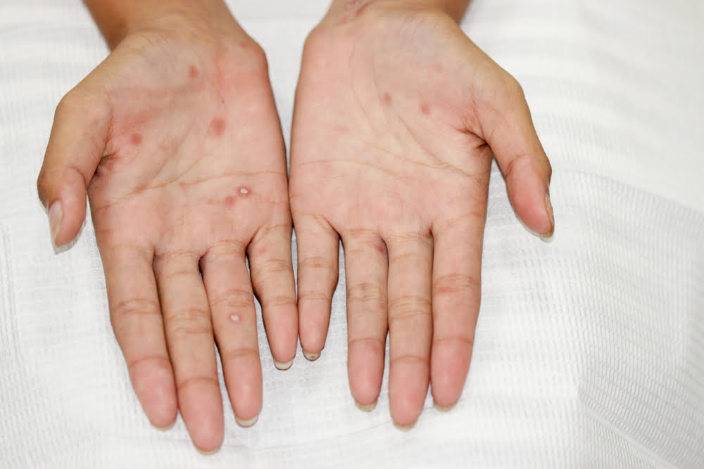 Breaking the Chain: How Syphilis TP-Ab Screening Can Stop the Spread
